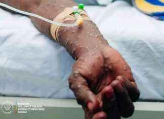 Intensification de la lutte contre le Mpox grâce à une importante donation de réactifs et équipements ntensification-de-la-lutte-contre-le-mpox-grce-une-importante-donation-de-ractifs-et-quipements