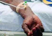 Outbreak of Mpox Cases in Nord-Kivu: Over 100 Cases Reported Since January 1st outbreak-of-mpox-cases-in-nord-kivu-over-100-cases-reported-since-january-1st