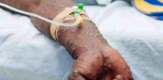 Outbreak of Mpox Cases in Nord-Kivu: Over 100 Cases Reported Since January 1st outbreak-of-mpox-cases-in-nord-kivu-over-100-cases-reported-since-january-1st